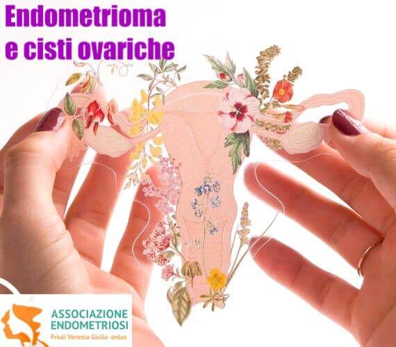 Cos'è una cisti endometriosica?